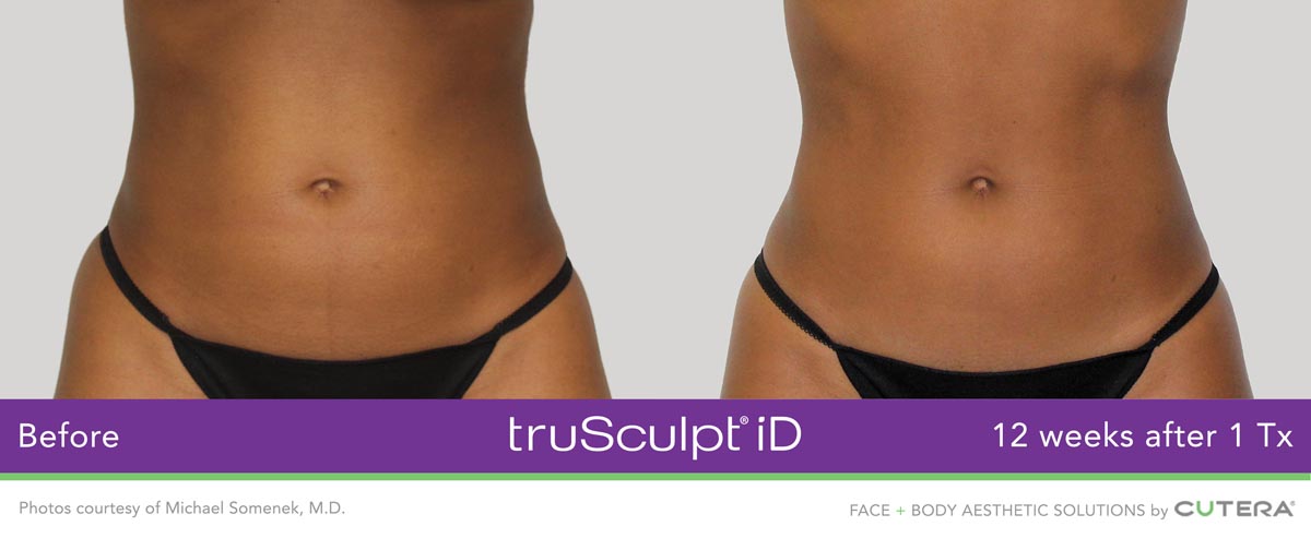 Lawrenceville Family Practice, PC, offers family medicine and med spa services like truSculpt id in Lawrenceville, GA.