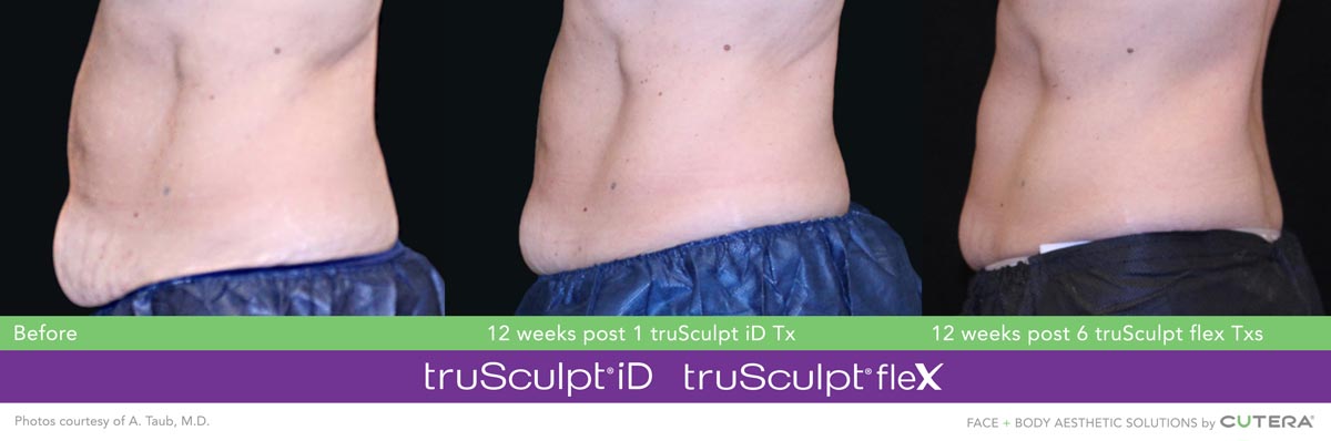 Lawrenceville Family Practice, PC, offers family medicine and med spa services like truSculpt flex in Lawrenceville, GA.